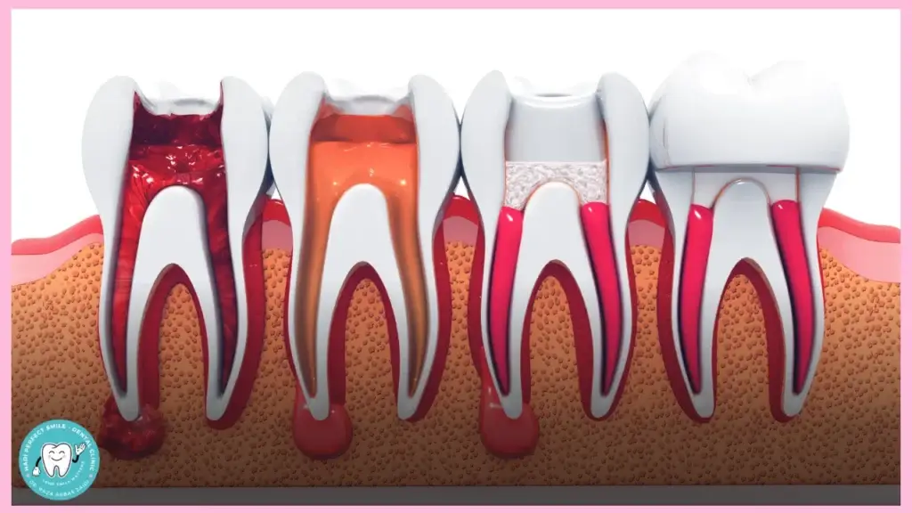 Signs You May Need RCT - Indications for Root Canal Treatment at Hadi Perfect Smile Dental Clinic.