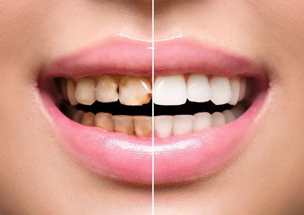 Teeth Bleaching and Whitening treatment at Hadi Perfect Smile Dental Clinic for a brighter smile.