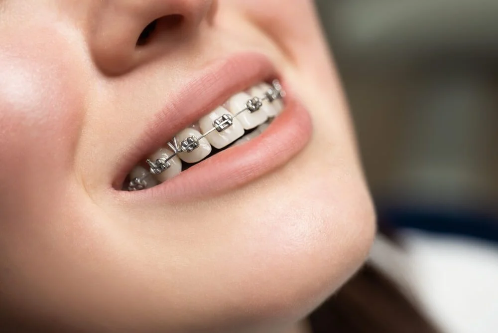 Braces treatment at Hadi Perfect Smile Dental Clinic for perfectly aligned teeth.