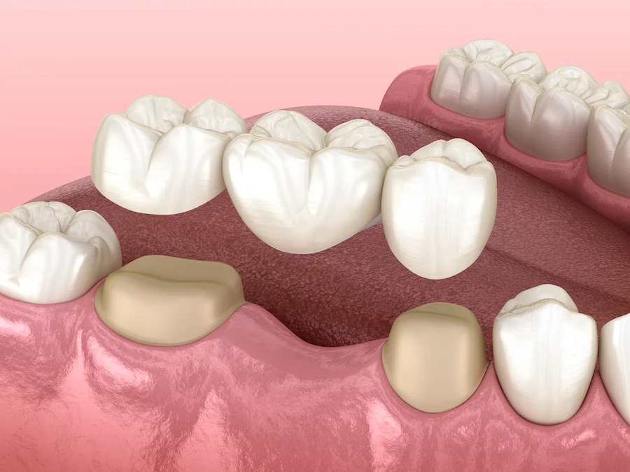 Crown & Bridge treatment at Hadi Perfect Smile Dental Clinic for a restored and confident smile.