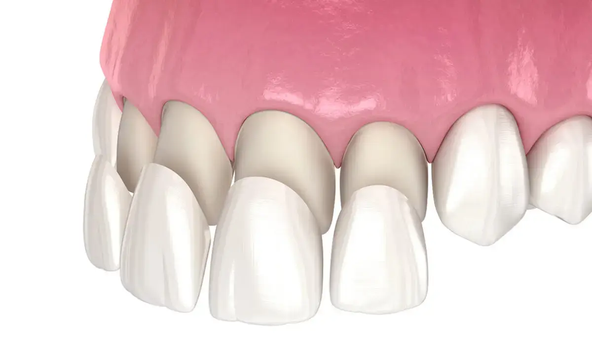 Dental Veneers treatment at Hadi Perfect Smile Dental Clinic for a flawless, natural-looking smile.