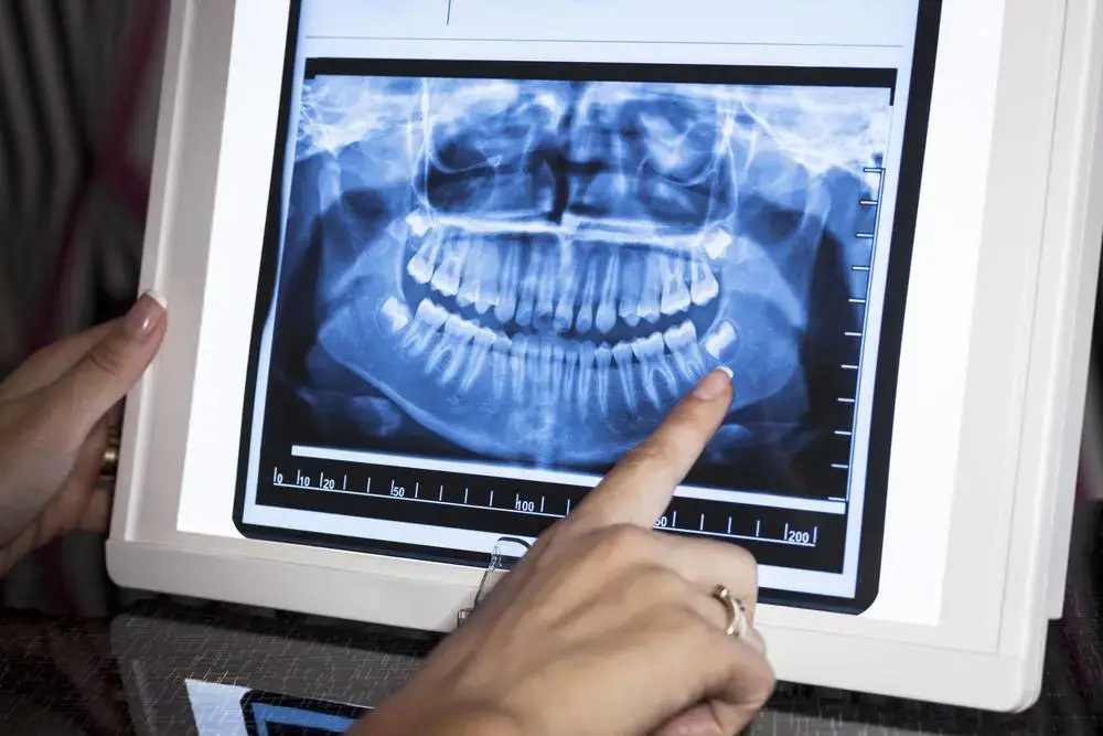 Digital X-Ray dental treatment at Hadi Perfect Smile Dental Clinic for precise diagnostics.