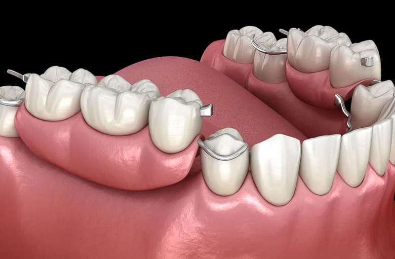Removable Partial Denture (RPD) treatment at Hadi Perfect Smile Dental Clinic for improved function and appearance.