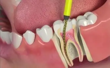 Root Canal Treatment (RCT) at Hadi Perfect Smile Dental Clinic for preserving natural teeth.