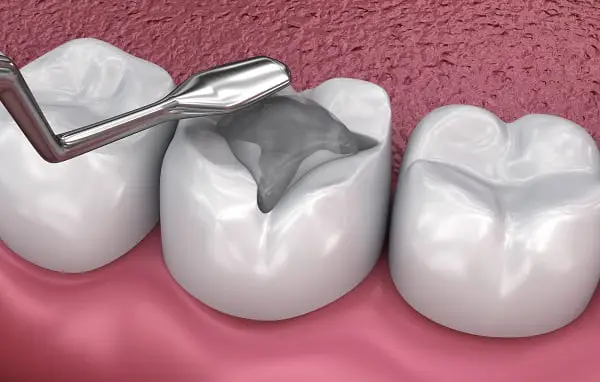 Teeth Filling treatment at Hadi Perfect Smile Dental Clinic for cavity restoration and improved oral health.