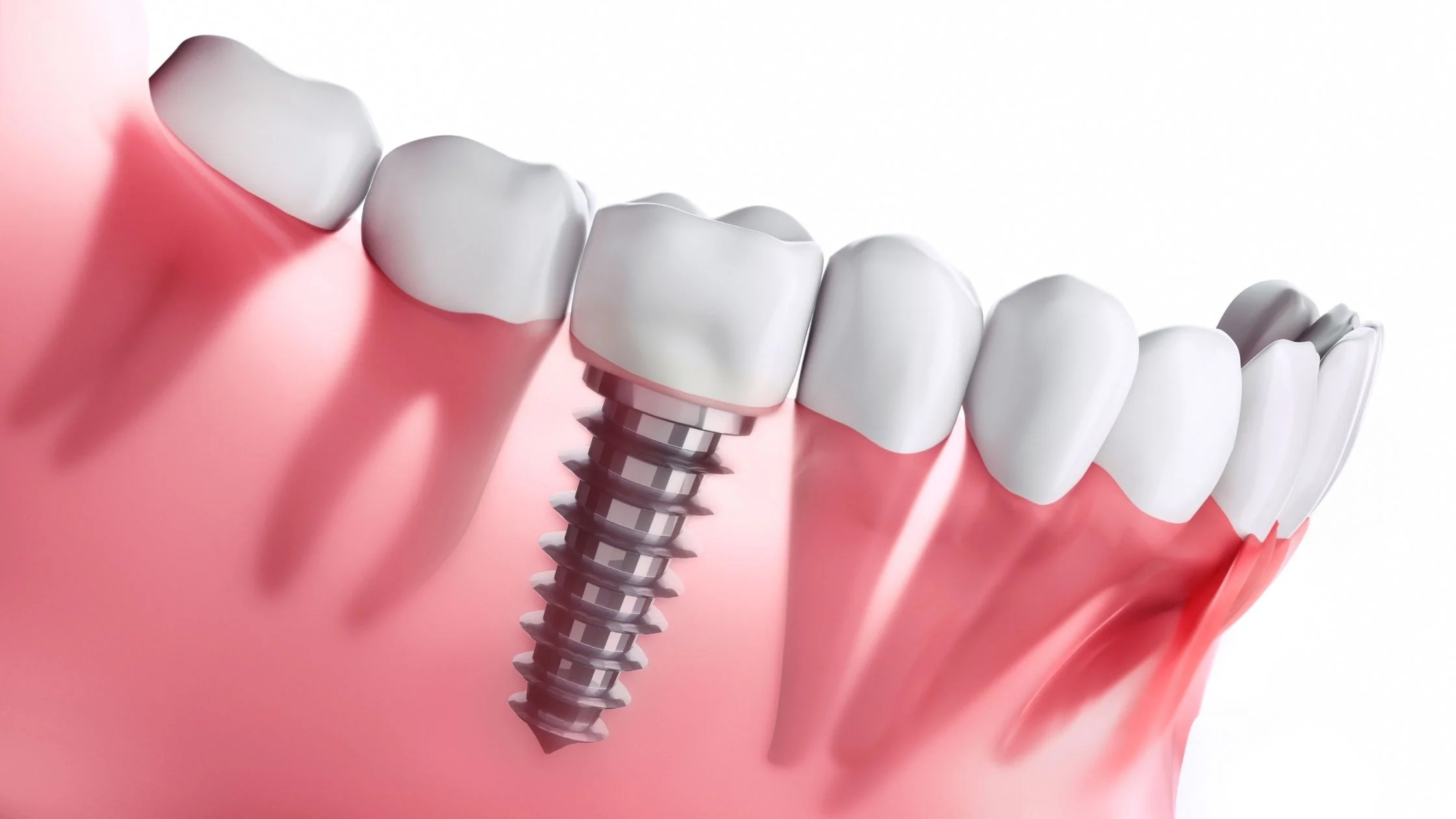 Teeth Implant treatment at Hadi Perfect Smile Dental Clinic for lasting dental solutions.