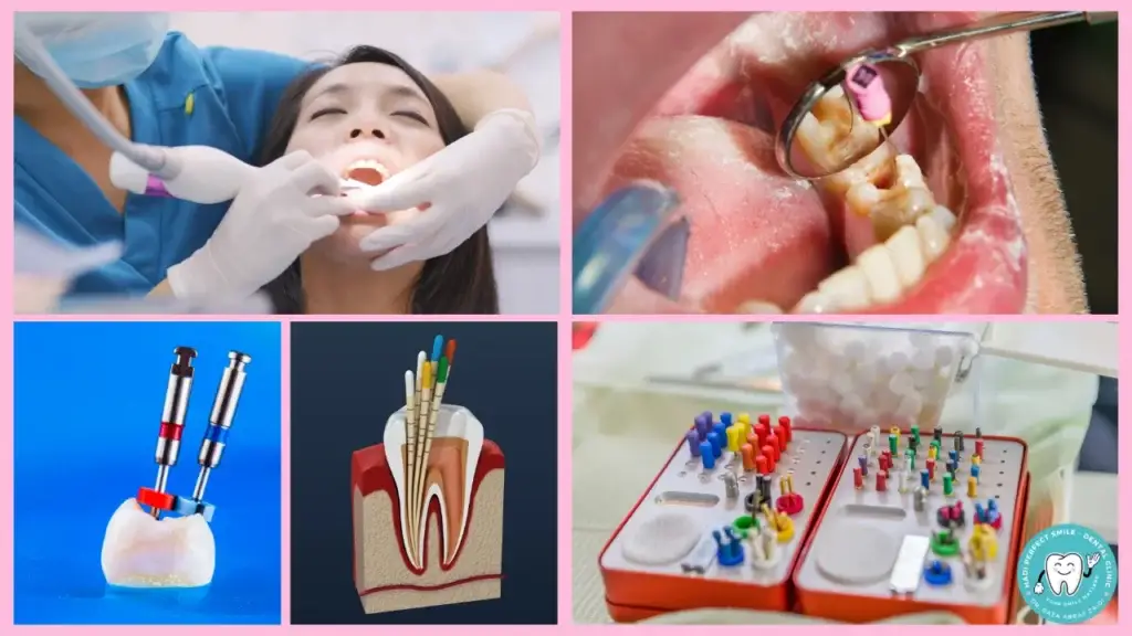 The RCT Procedure - Step-by-Step Root Canal Treatment at Hadi Perfect Smile Dental Clinic.