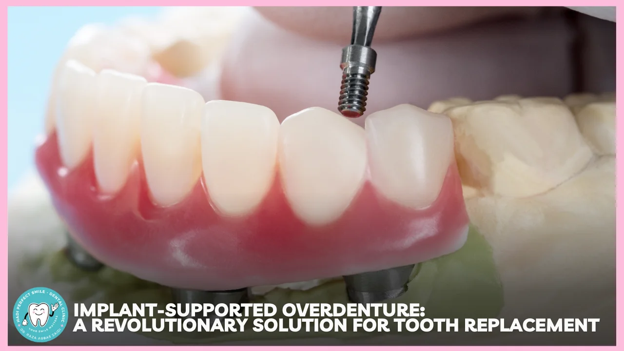 Implant-Supported Overdenture: A Revolutionary Solution for Tooth Replacement – Hadi Perfect Smile Dental Clinic