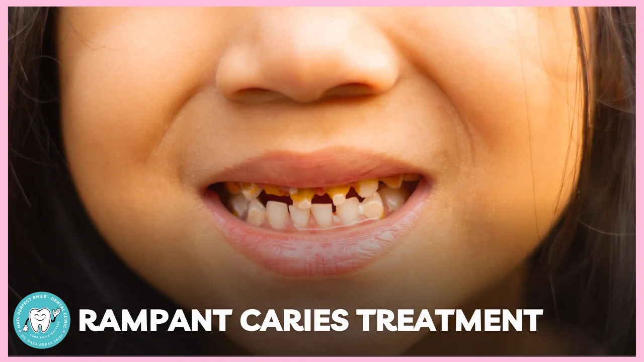 A dentist examining a patient’s teeth showing multiple cavities caused by rampant caries at Hadi Perfect Smile Dental Clinic in Delhi