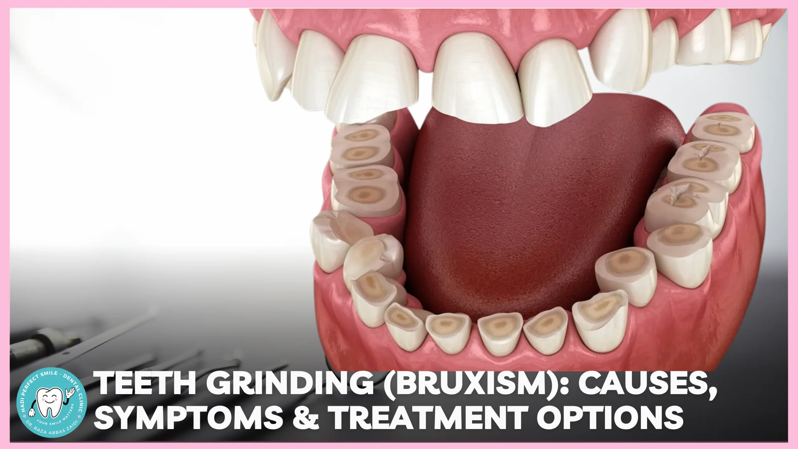 Illustration showing teeth grinding and jaw clenching during sleep.