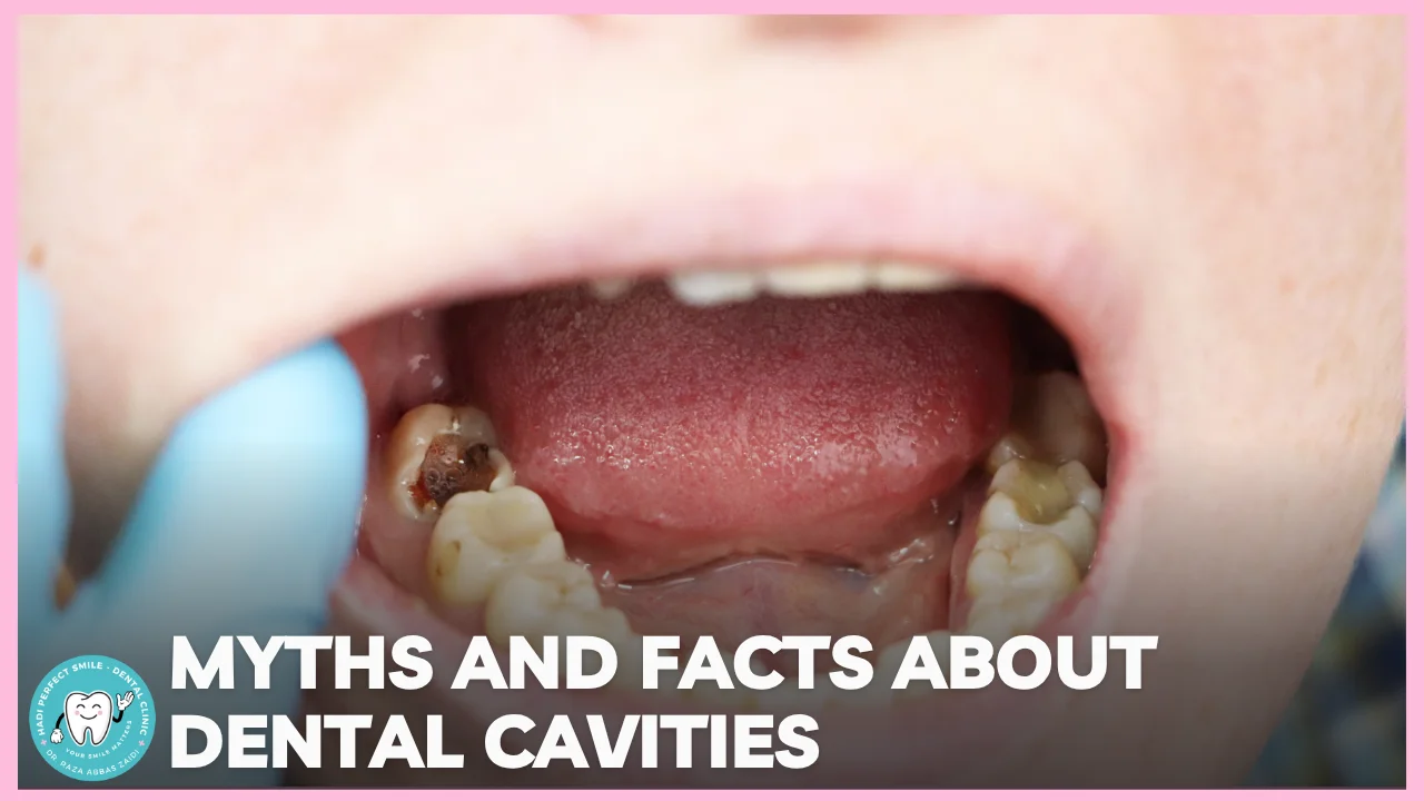 Illustration comparing common myths and facts about dental cavities and tooth decay.