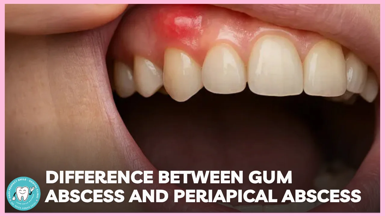 Dental illustration comparing a gum abscess and a periapical abscess around a tooth.