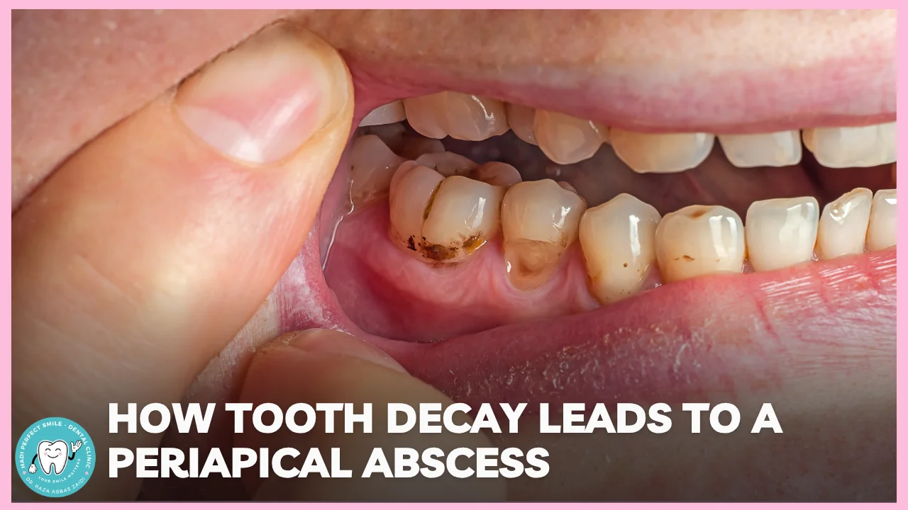 Cross-sectional illustration showing tooth decay progressing into a periapical abscess at the root tip.