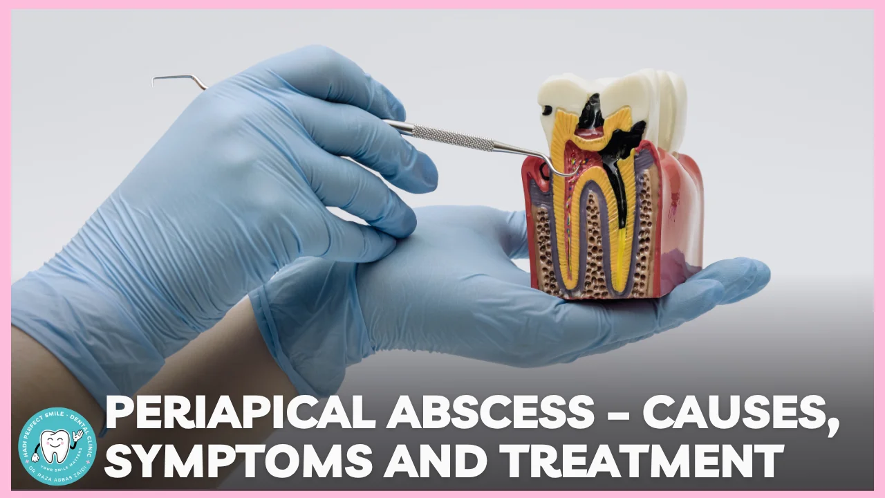Illustration showing a tooth with a periapical abscess at the root tip.